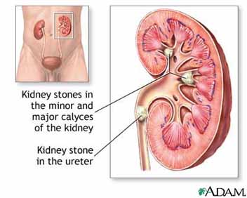 kidneystone