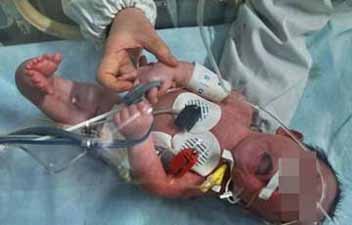 baby undergoing dialysis 1