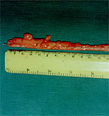 LARGEST APPENDIX REMOVED